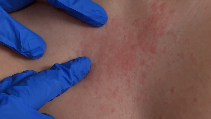 Alerta Sanitaria por Brote de Sarampión en Mexicali